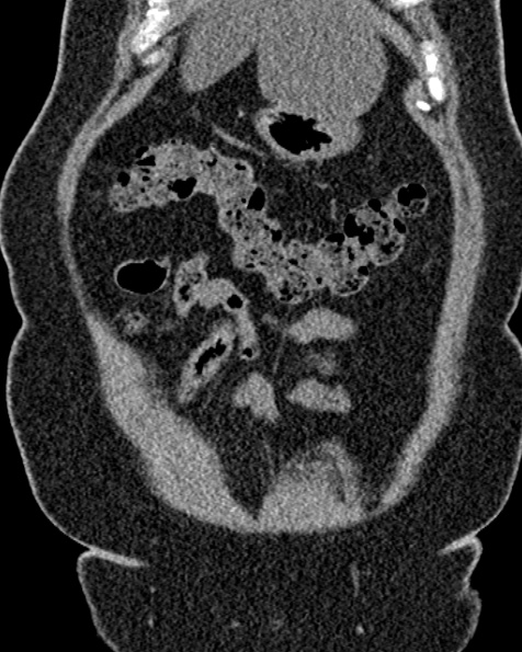 File:Nephrostomy for urosepsis (Radiopaedia 26180-26330 non-contrast 18).jpg