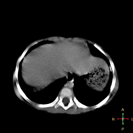 File:Neuroblastoma (Radiopaedia 24751-25016 D 3).jpg