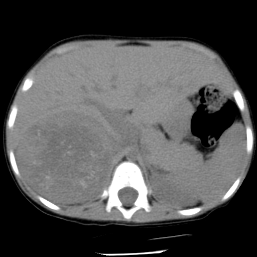 File:Neuroblastoma (Radiopaedia 7746-8572 Axial non-contrast 1).jpg