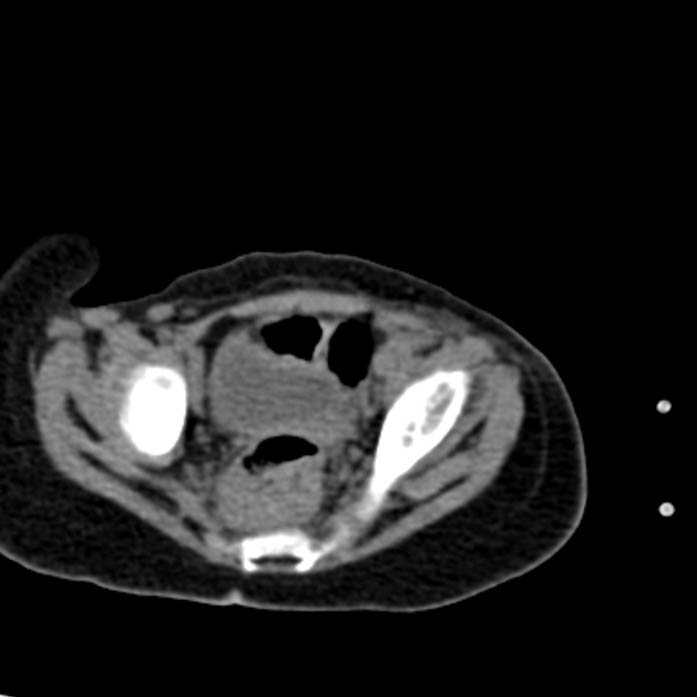 Neuroblastoma with skull metastases (Radiopaedia 30326-30960 Axial non-contrast 54).jpg