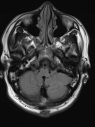 File:Neurofibromatosis type 2 (Radiopaedia 44936-48838 Axial FLAIR 4).png