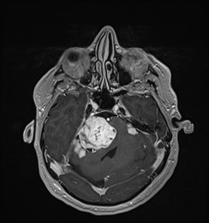Neurofibromatosis type 2 (Radiopaedia 79097-92049 Axial T1 C+ 64).jpg