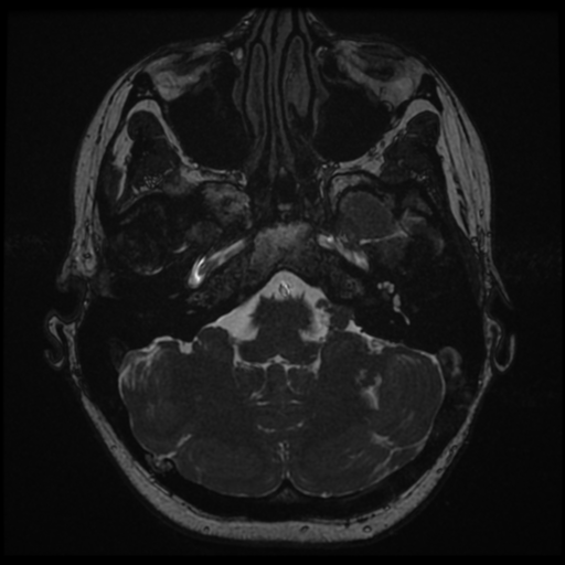 Neurofibromatosis type 2 - bilateral acoustic neuromata (Radiopaedia 40060-42566 Axial FIESTA 27).png