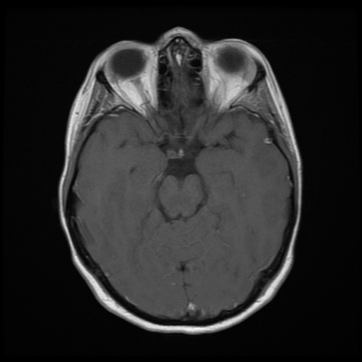 File:Neurofibromatosis type 2 - bilateral acoustic neuromata (Radiopaedia 40060-42566 Axial T1 C+ 8).png