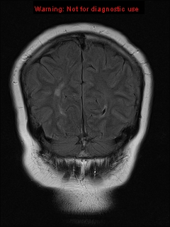 File:Neuroglial cyst (Radiopaedia 10713-11184 Coronal FLAIR 6).jpg