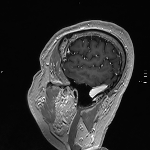 Neurosarcoidosis - involvement of the mesial temporal lobes (Radiopaedia 67429-76820 Sagittal T1 C+ 144).jpg