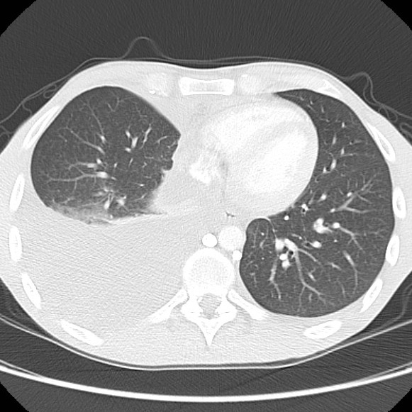 File:Non-Hodgkin lymphoma involving lung (Radiopaedia 29094-29470 Axial lung window 47).jpg