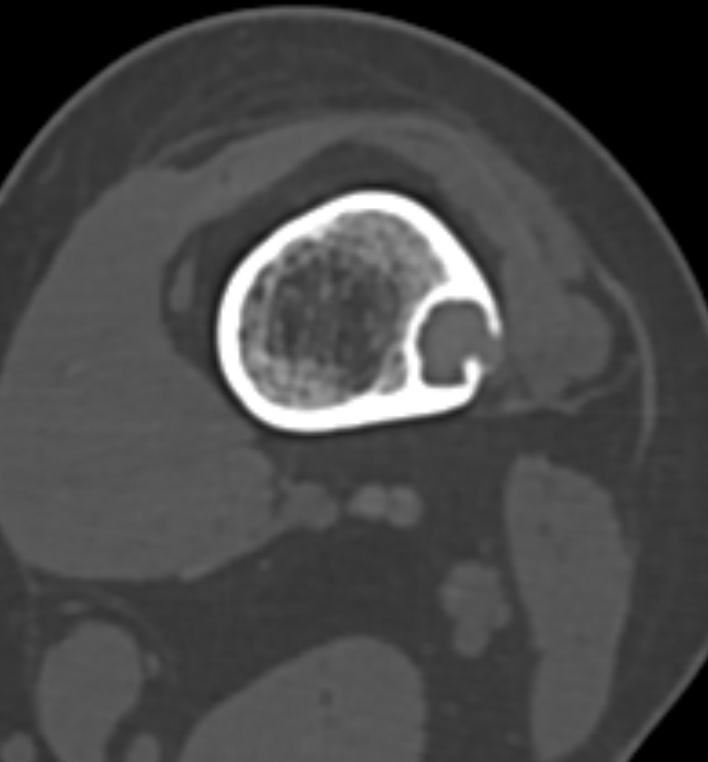 Non-ossifying fibroma - femur (Radiopaedia 82786-97042 Axial bone window 40).jpg
