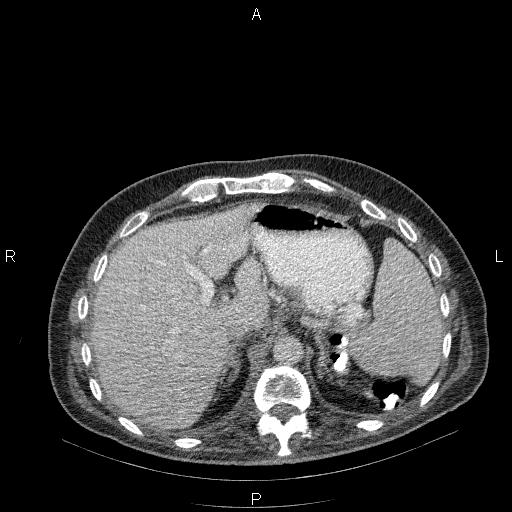 File:Non Hodgkin lymphoma in a patient with ankylosing spondylitis (Radiopaedia 84323-99624 B 28).jpg