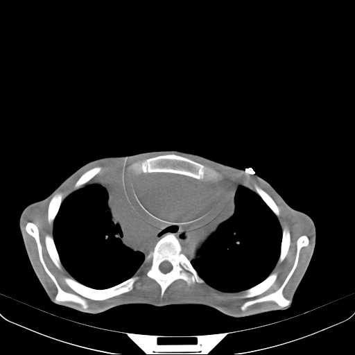 File:Non hodgkin lymphoma of the mediastinum (Radiopaedia 20814-20729 Axial non-contrast 10).jpg
