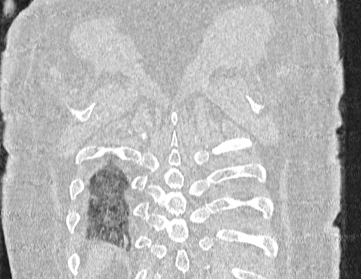 Non specific interstitial pneumonia (NSIP) (Radiopaedia 89725-106798 Coronal lung window 68).jpg