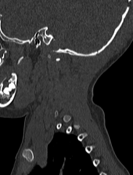 File:Normal CT cervical spine - pediatric (Radiopaedia 52549-58462 Sagittal bone window 7).jpg