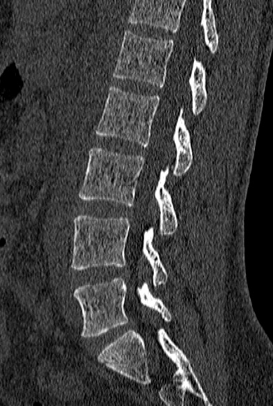 File:Normal CT lumbar spine (Radiopaedia 53981-60118 Sagittal bone window 57).jpg