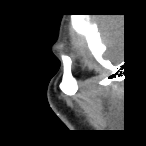 Normal CT paranasal sinuses (Radiopaedia 42286-45390 F 21).jpg