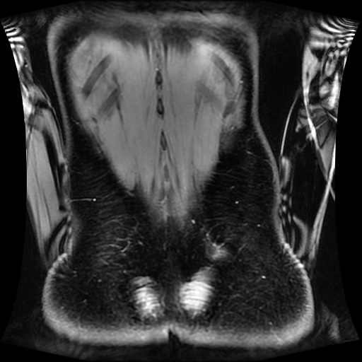 Normal MRI abdomen in pregnancy (Radiopaedia 88001-104541 M 123).jpg