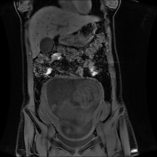 Normal MRI abdomen in pregnancy (Radiopaedia 88001-104541 M 52).jpg