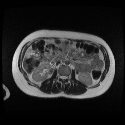 Normal MRI abdomen in pregnancy (Radiopaedia 88003-104546 Axial T2 14).jpg