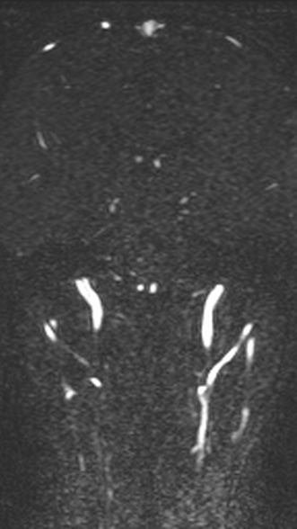 Normal MRI brain with MRV- teenager (Radiopaedia 49425-54553 Coronal MRV 143).jpg