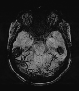 Normal MRI internal auditory canal (Radiopaedia 41613-44525 Axial SWI MIP 26).png