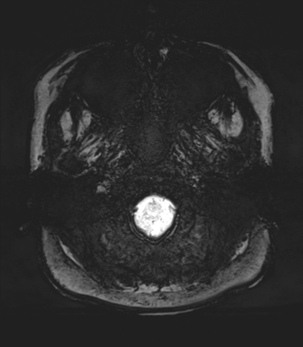 Normal MRI internal auditory canal (Radiopaedia 41613-44525 Axial SWI MIP 4).png