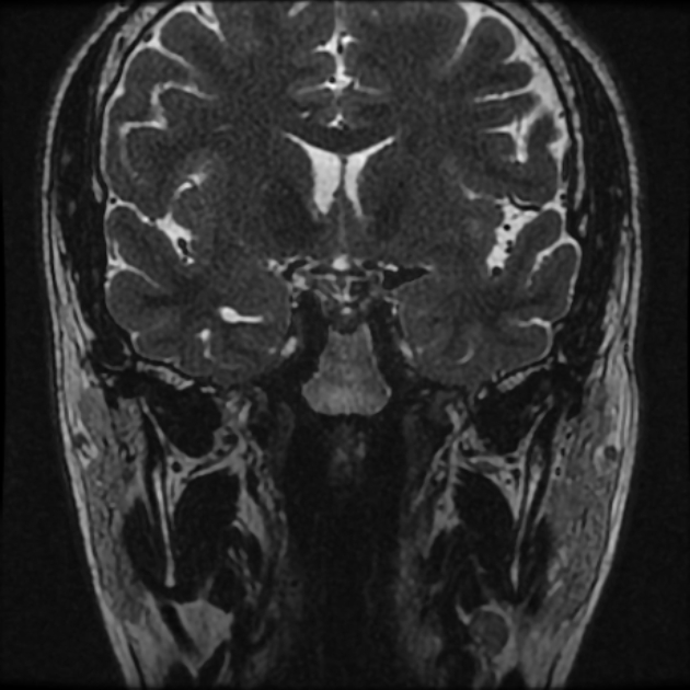 Normal MRI petrous (Radiopaedia 91317-108949 Coronal T2 5).jpg