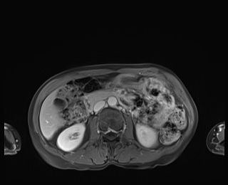 Normal adrenal glands MRI (Radiopaedia 82017-96004 M 45).jpg
