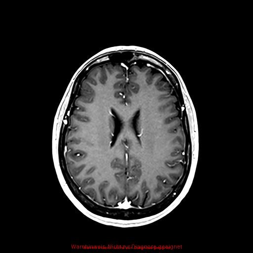 Normal adult brain MRI (non-enhanced and contrast-enhanced) (Radiopaedia 75262-86379 Axial T1 C+ 124).jpg
