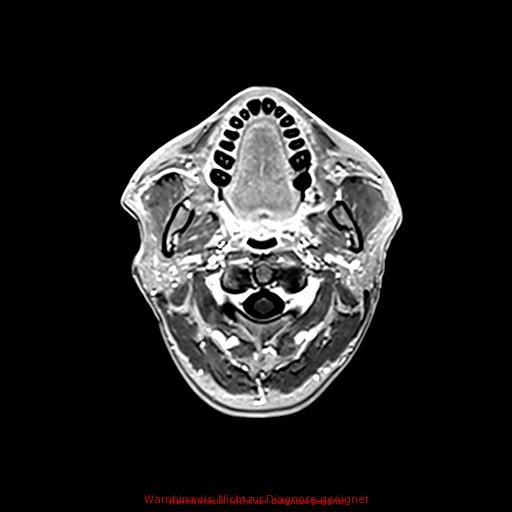 Normal adult brain MRI (non-enhanced and contrast-enhanced) (Radiopaedia 75262-86379 Axial T1 C+ 25).jpg