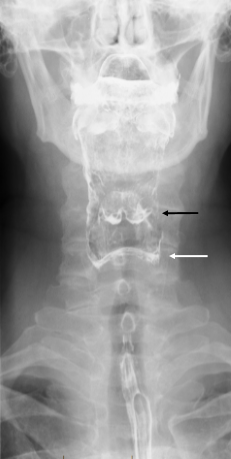 File:Normal barium swallow - AP projection of hypopharynx (Radiopaedia 10151-83305 Frontal 1).PNG