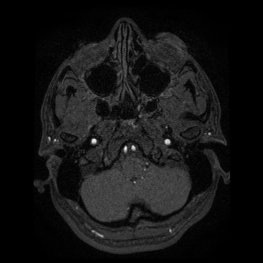 Normal brain MRA (Radiopaedia 41046-43793 Axial MRA 108).png