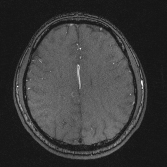 Normal brain MRI including MRA (Radiopaedia 48748-53763 Axial MRA 149).jpg