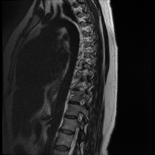 File:Normal cervical and thoracic spine MRI (Radiopaedia 35630-37156 G 3).png