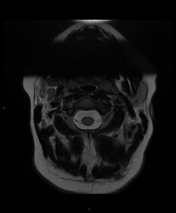 Normal cervical spine MRI (Radiopaedia 80146-93454 Axial T2 1).jpg