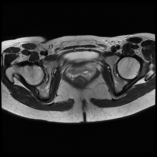 File:Normal female pelvis MRI (retroverted uterus) (Radiopaedia 61832-69933 Axial T2 23).jpg