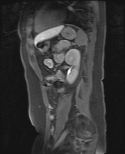 File:Normal hepatobiliary phase liver MRI (Radiopaedia 58968-66230 C 54).jpg