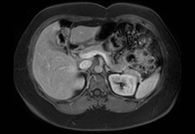 Normal liver MRI with Gadolinium (Radiopaedia 58913-66163 J 39).jpg