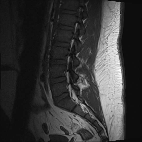 File:Normal lumbar spine MRI (Radiopaedia 47857-52609 Sagittal T1 7).jpg