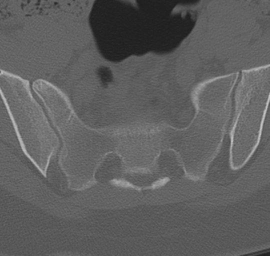 File:Normal lumbosacral CT (Radiopaedia 37923-39867 Axial bone window 90).png