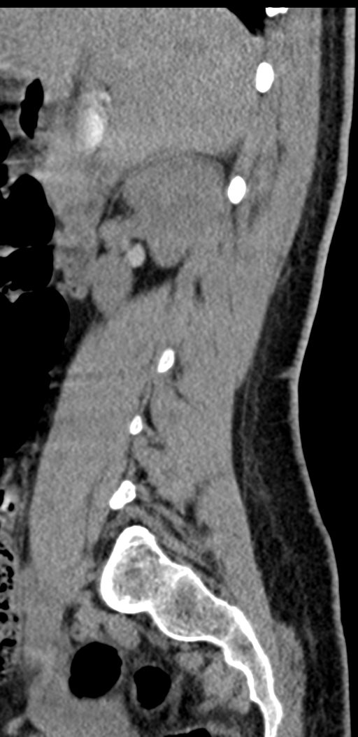 Normal lumbosacral CT (Radiopaedia 37923-39867 E 81).png
