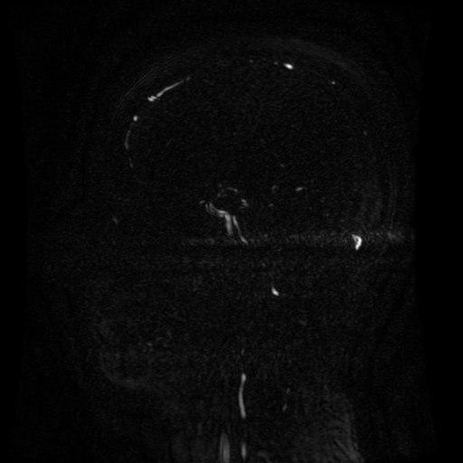 Normal noncontrast MR venography (Radiopaedia 87578-103957 A 70).jpg