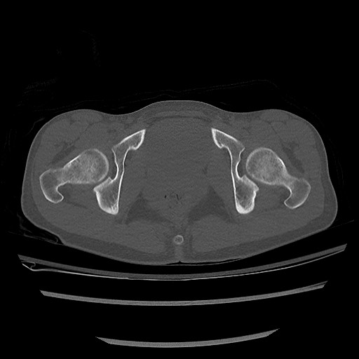 Normal pelvis CT (Radiopaedia 51471-57236 Axial bone window 79).jpg