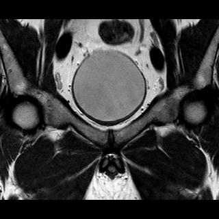 File:Normal prostate (MRI) (Radiopaedia 29986-30535 Coronal T2 3).jpg