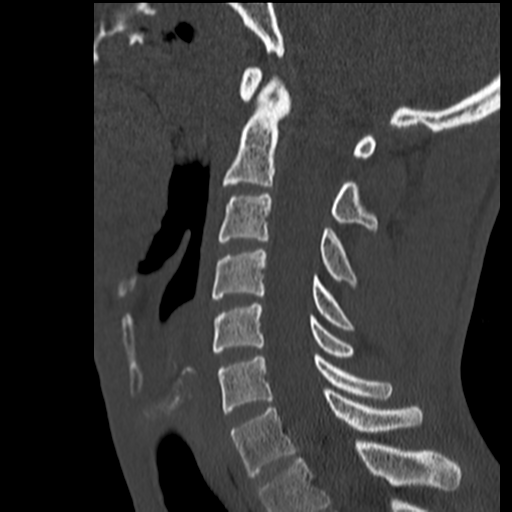 File:Normal trauma cervical spine (Radiopaedia 41017-43760 Sagittal bone window 24).png