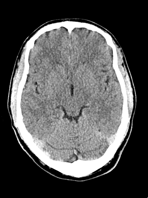 Normal trauma protocol brain and C-spine CT (Radiopaedia 83302-97709 Axial non-contrast 44).jpg