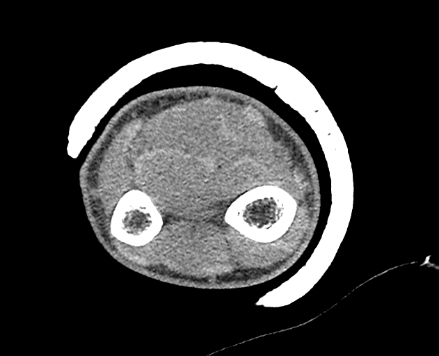 Normal wrist CT (Radiopaedia 41425-44297 Axial non-contrast 53).png