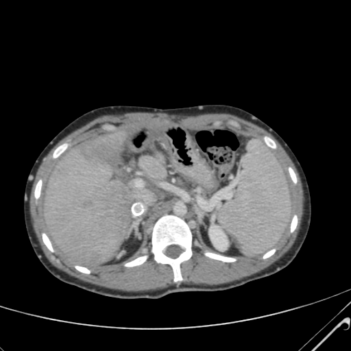 File:Nutmeg liver- Budd-Chiari syndrome (Radiopaedia 46234-50635 B 19).png