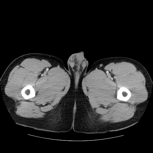 File:Obstructing ureteric calculus (Radiopaedia 18615-18514 B 65).jpg