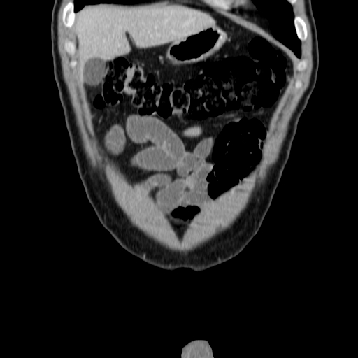 File:Obstructing ureteric calculus (Radiopaedia 18615-18514 C 10).jpg