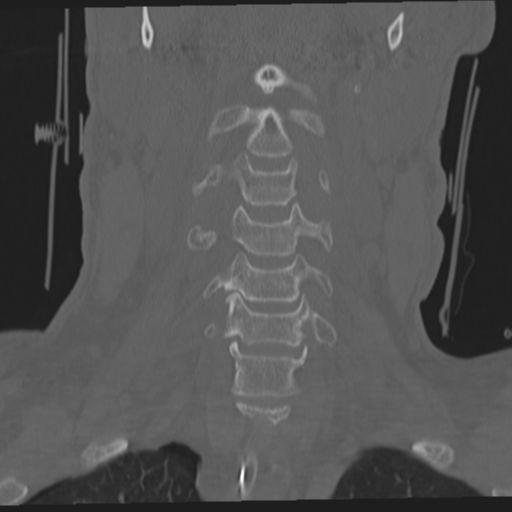 File:Occipital condyle fracture (Radiopaedia 33467-34517 Coronal bone window 23).png