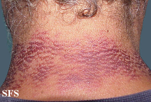 File:Pellagra (Dermatology Atlas 12).jpg